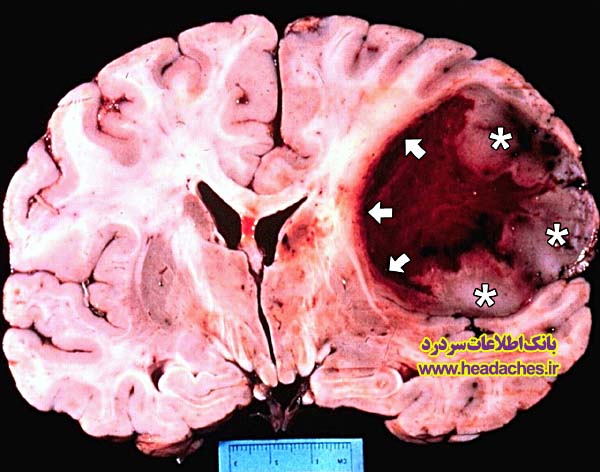 تومور مغزی-brain tumor